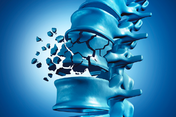 Innere Medizin - Osteoporose